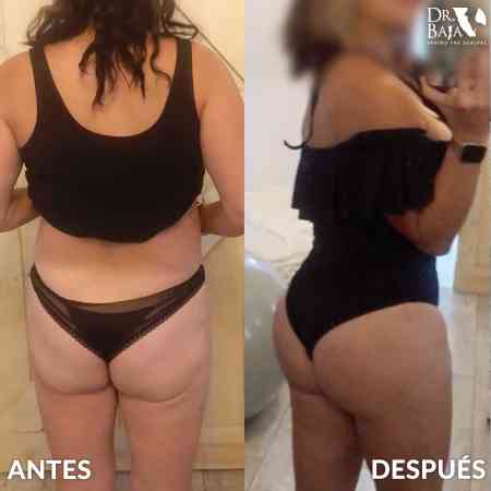 Transferencia de Grasa a Glúteos-62