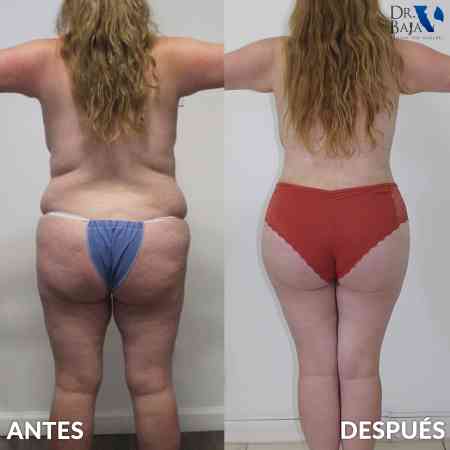 Transferencia de Grasa a Glúteos-64