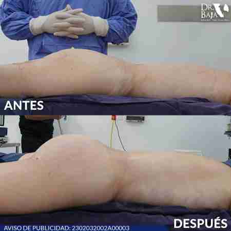 Brazilian Butt Lift-65