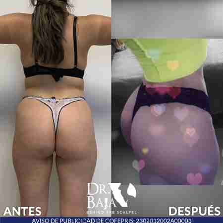 Brazilian Butt Lift-69