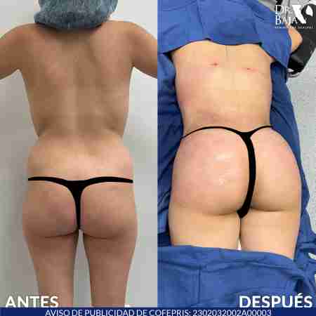 Brazilian Butt Lift-72