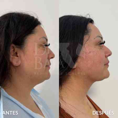 endolifting-facial-antes-y-despues-1