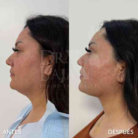 endolifting-facial-antes-y-despues-2