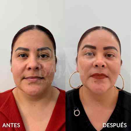endolifting-facial-antes-y-despues-4