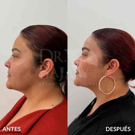 endolifting-facial-antes-y-despues-5