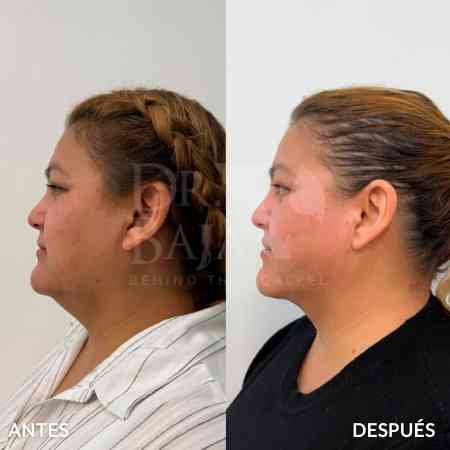 endolifting-facial-antes-y-despues-7