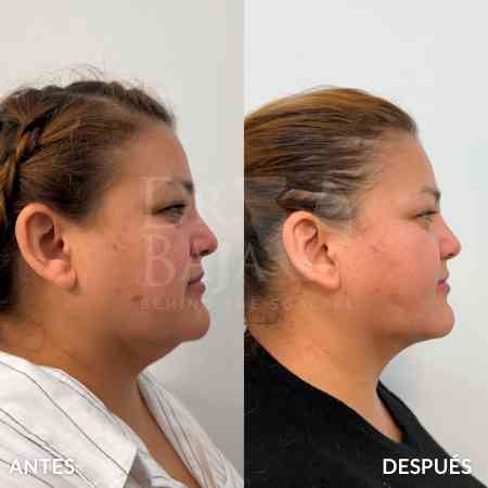 endolifting-facial-antes-y-despues-8