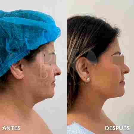 endolifting-facial-antes-y-despues-9