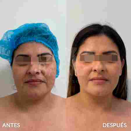 endolifting-facial-antes-y-despues-10