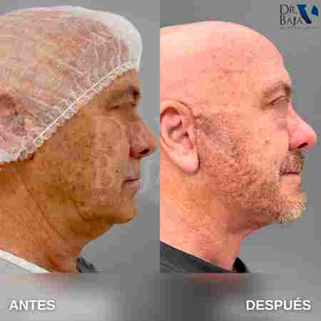 Facelift-5