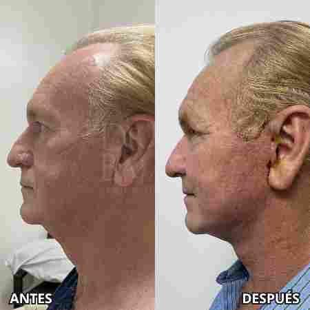 Lifting Facial-22