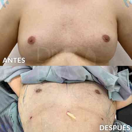 Ginecomastia-6