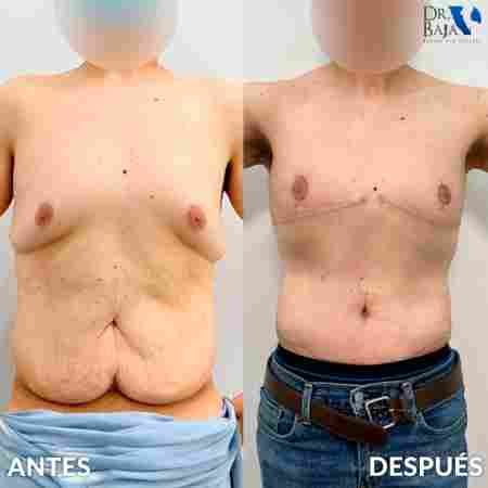 Gynecomastia-11