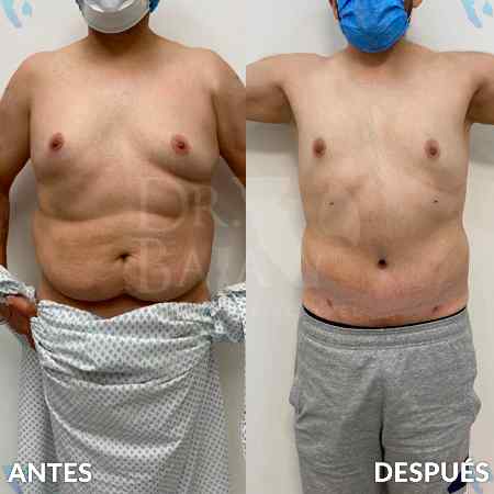 Lipectomía-4