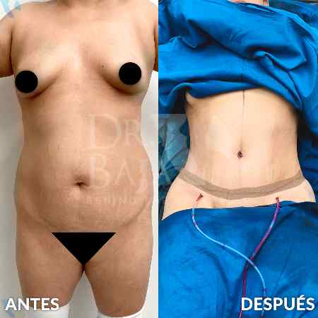Lipectomía-6