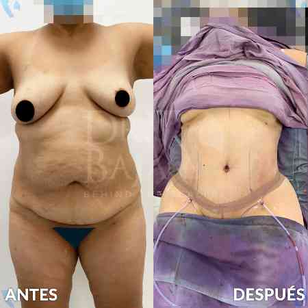 Tummy Tuck-6