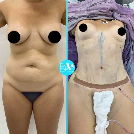 Tummy Tuck-11