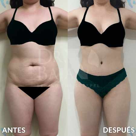Tummy Tuck-13