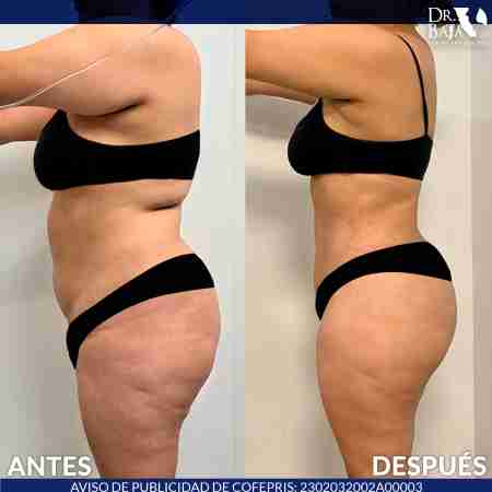 Tummy Tuck-17