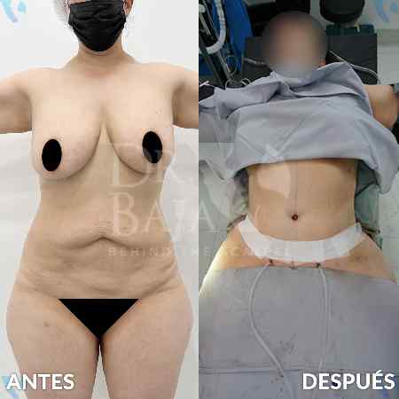 Lipectomía-19