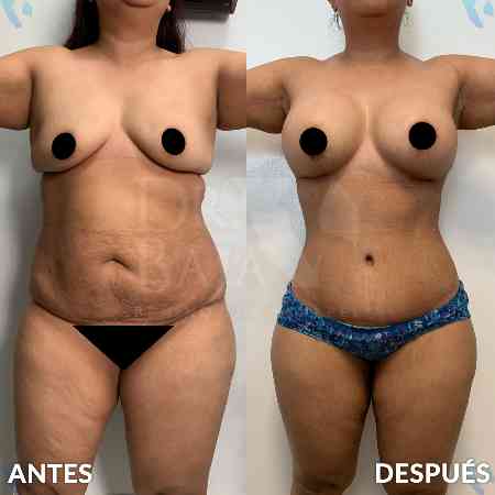 Tummy Tuck-21