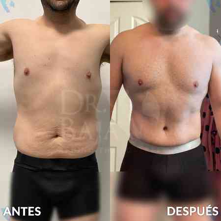 Lipectomía-28