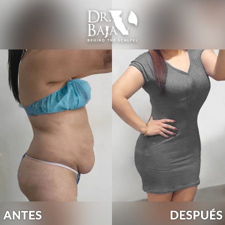 Lipectomía-31
