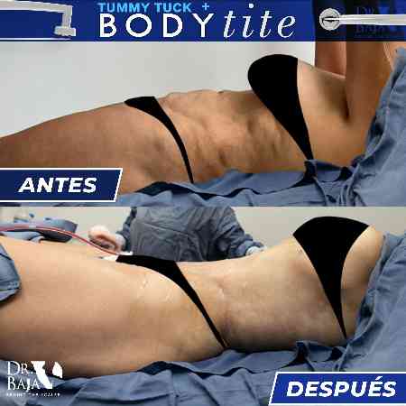 Lipectomía-33