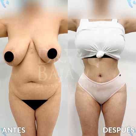 Tummy Tuck-40