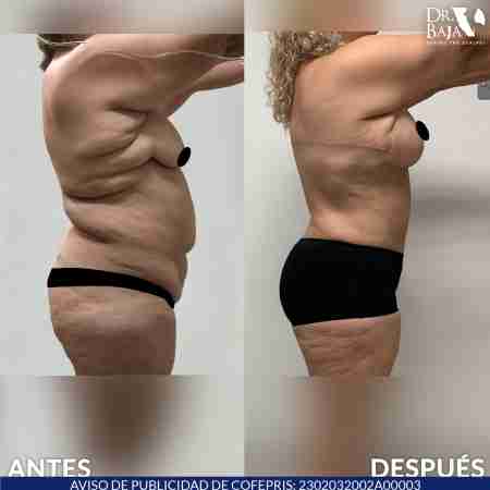 Lipectomía-58