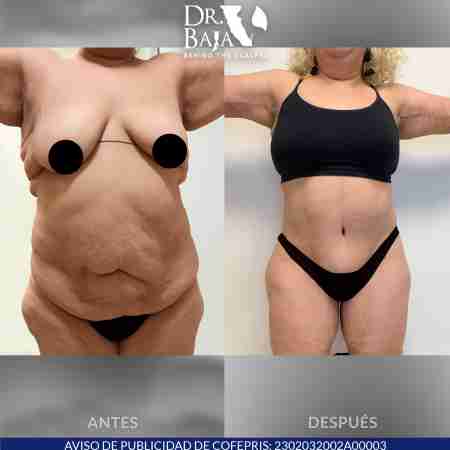 Tummy Tuck-61