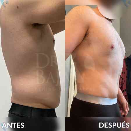 Lipectomía-2