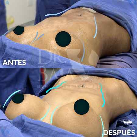 Lipoescultura HD-3
