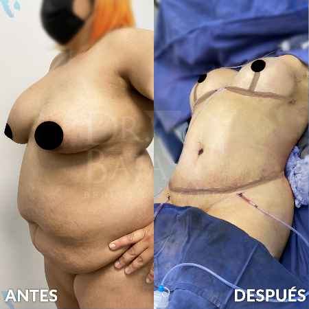 Lipoescultura HD-4