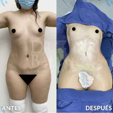 Liposculpture HD-5