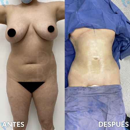 Lipoescultura HD-6