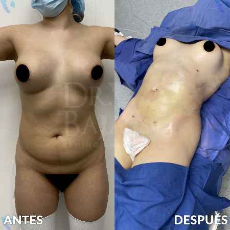 Lipoescultura HD-9