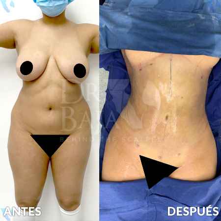 Liposculpture HD-10