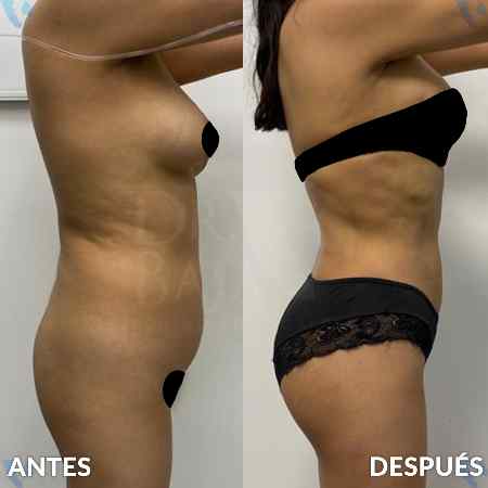 Lipoescultura HD-11
