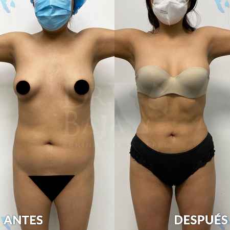 Liposculpture HD-12