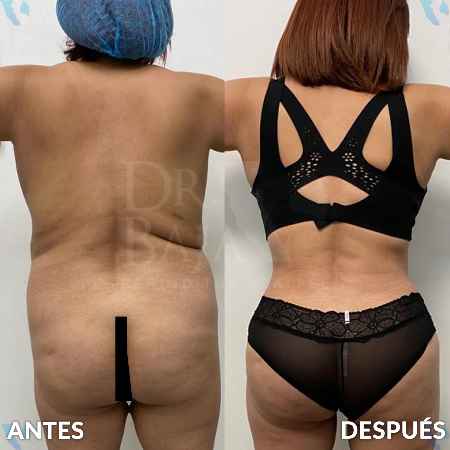 Liposculpture HD-13