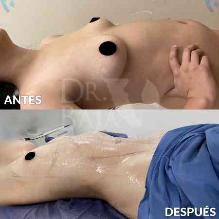 Liposculpture HD-19