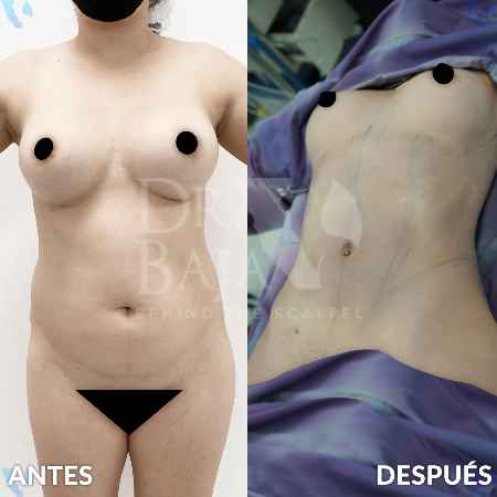 Lipoescultura HD-20