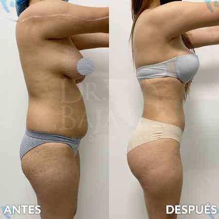 Liposculpture HD-22