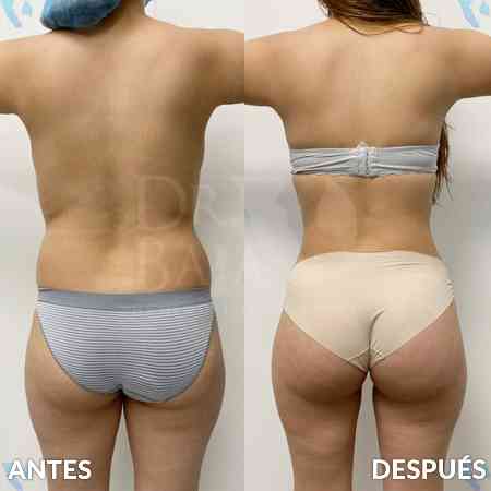 Liposculpture HD-23