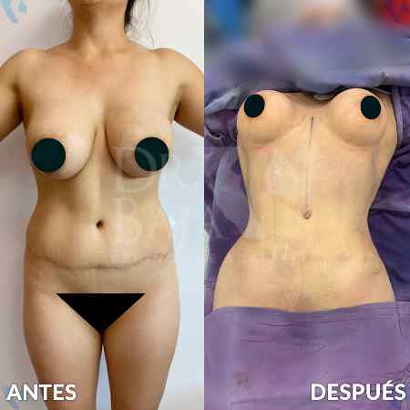 Lipoescultura HD-25