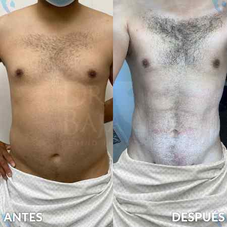Liposculpture HD-26
