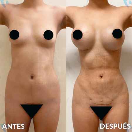 Lipoescultura HD-26