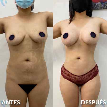 Lipoescultura HD-30