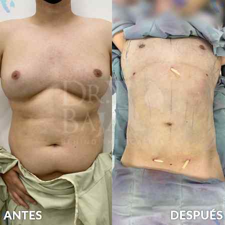 Lipoescultura HD-33